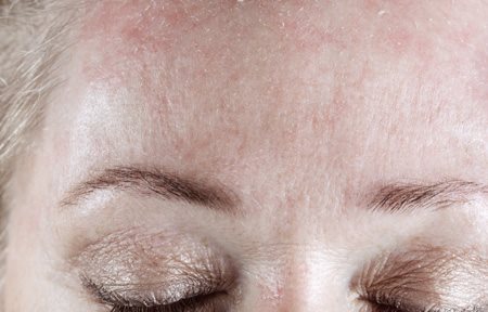 Mujer con descamación en la frente